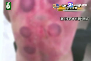 男子拔罐时着了火 老板:关我什么事